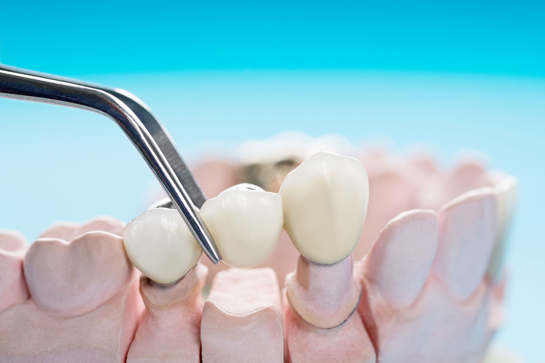 Traditonal Dental Bridge West Covina CA